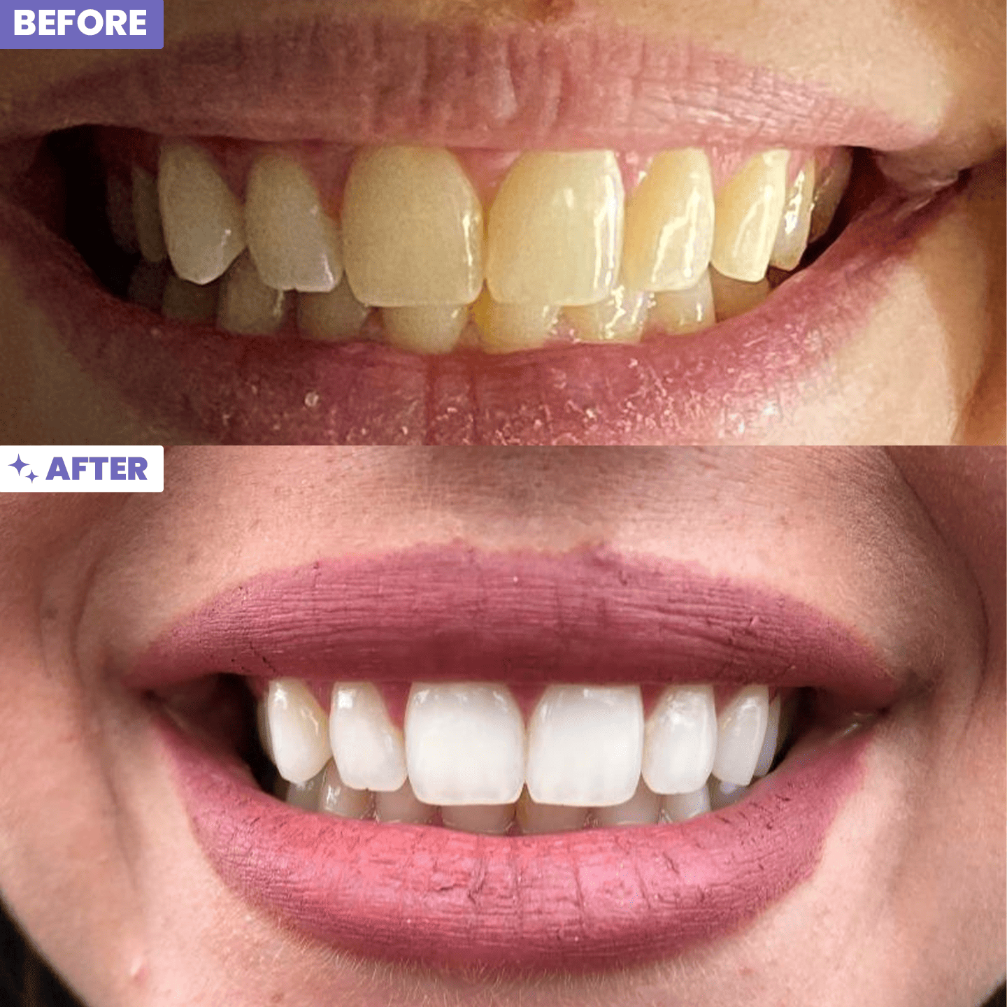 Pandore Whitening Kit™